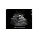 Blue Phantom Renal Biopsy Ultrasound Training Model