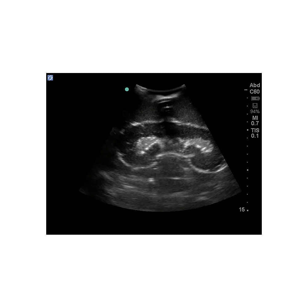 Blue Phantom Renal Biopsy Ultrasound Training Model